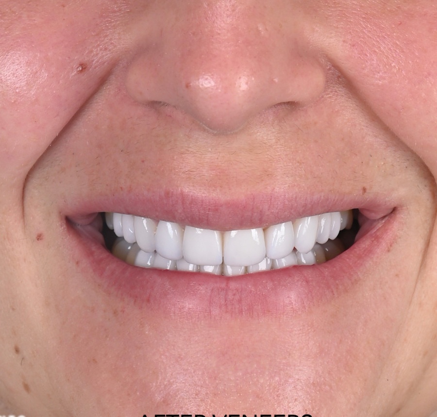 After cosmetic treatment
